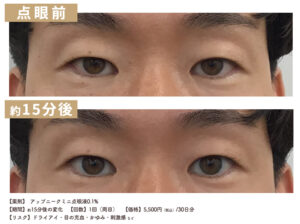 アップニーク点眼薬による眼瞼下垂改善の症例写真（点眼15分後）